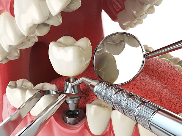 Best Knocked-Out Tooth (Avulsed Tooth) Treatment in Albany, OR